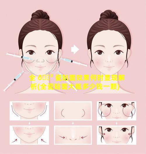 全 🐳 瓷贴面效果何时显现解析(全瓷贴面大概多少钱一颗)